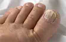 Nails and Deficiency, vitamin deficiency nail Vitamin Deficiency Symptoms nails show